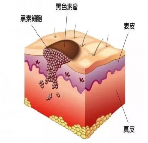 恶性黑色素瘤