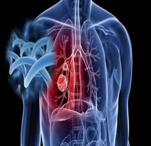 常见恶性肿瘤筛查和预防推荐——肺癌
