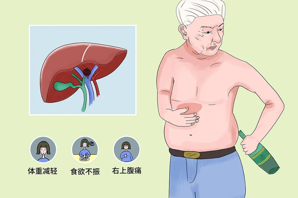 抗癌必修课——肝癌