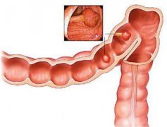 出现这些症状需马上到医院检查——结肠癌