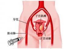 子宫栓塞介入手术过程